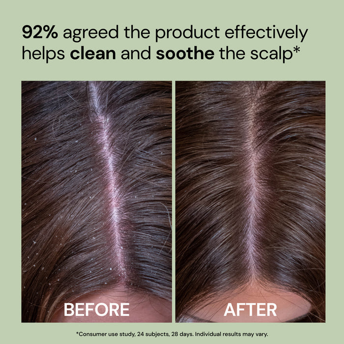 Before and after scalp part comparison showing "92% agreed the product effectively helps clean and soothe the scalp*"

*Consumer use study, 24 subjects, 28 days. Individual results may vary"